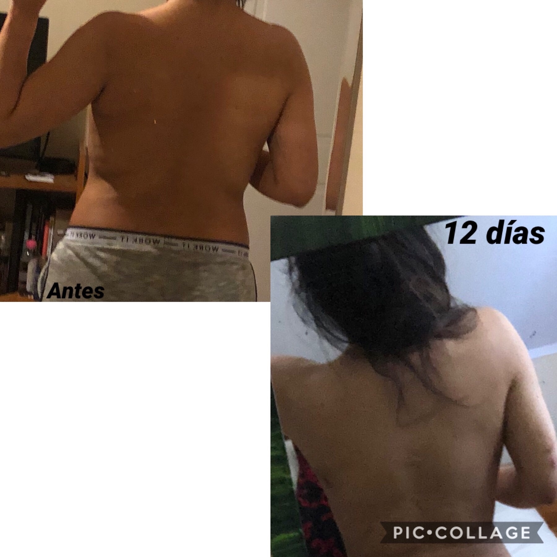 Lipo de abdomen y espalda